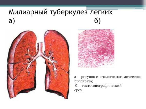 Диссеминированный туберкулез макропрепарат