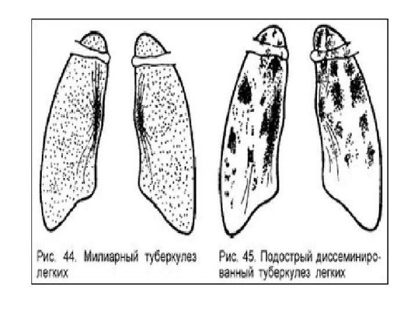 Диссеминированный туберкулез легких схема