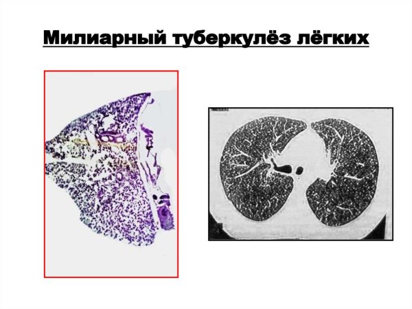 Милиарный туберкулёз лёгкого