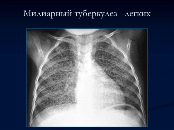 Острый милиарный диссеминированный туберкулез