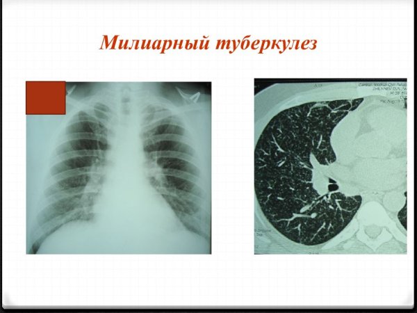 Острый милиарный туберкулез