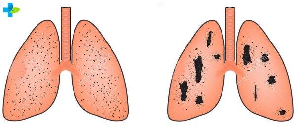 Легкие больного туберкулезом и здорового