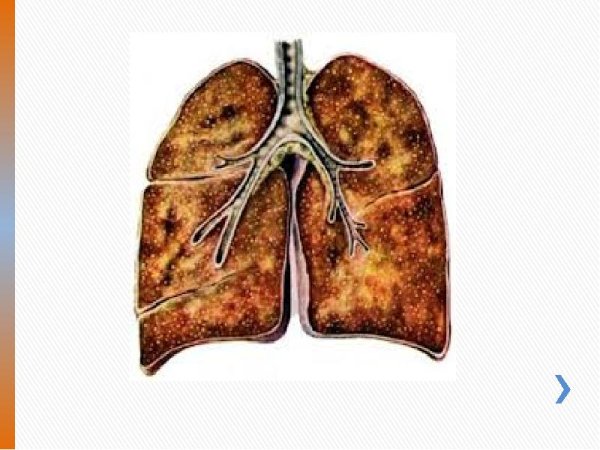 Милиарный туберкулез легких у детей