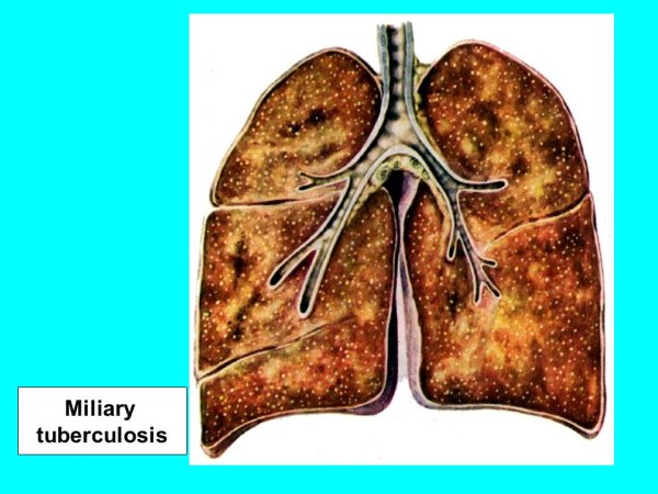 Милиарный туберкулез легких макропрепарат