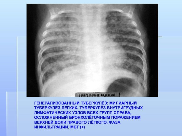 Милиарный туберкулез МБТ