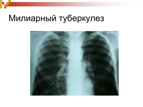 Острый милиарный туберкулез рентген