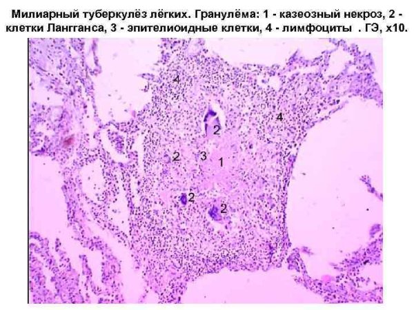 Милиарный туберкулез легкого микропрепарат