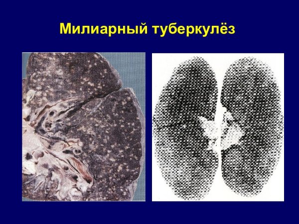 Милиарный диссеминированный туберкулез