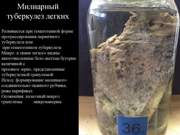Туберкулёз лёгкого макропрепарат