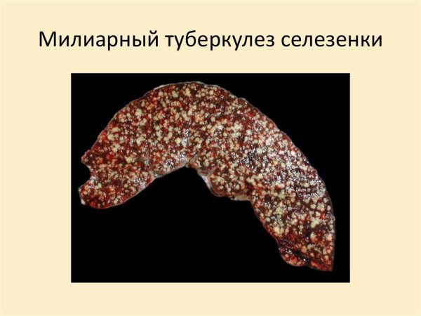 Милиарный туберкулез печени