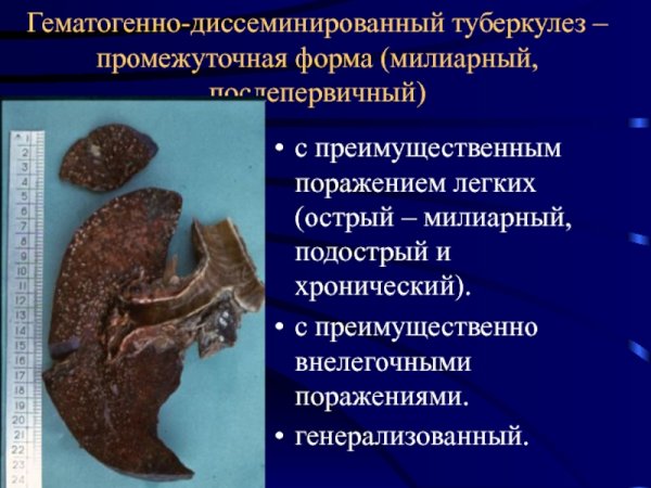 Диссеминированный туберкулез патанатомия