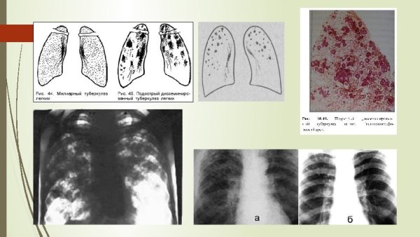 Хронический диссеминированный туберкулез кт