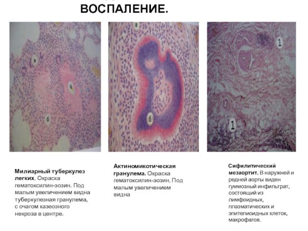 Туберкулез легких гематоксилин-эозин)