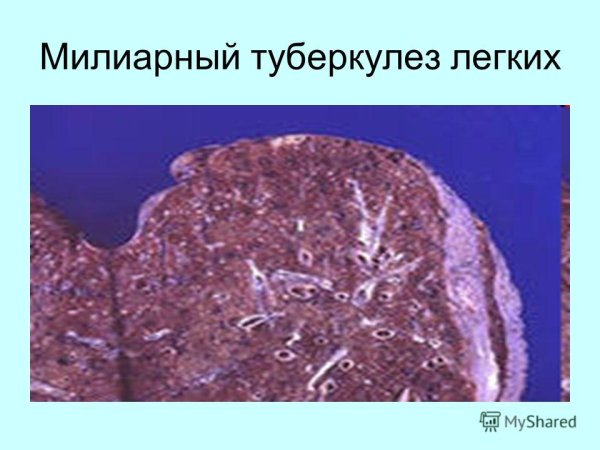 Милиарный туберкулёз лёгких рентген описание