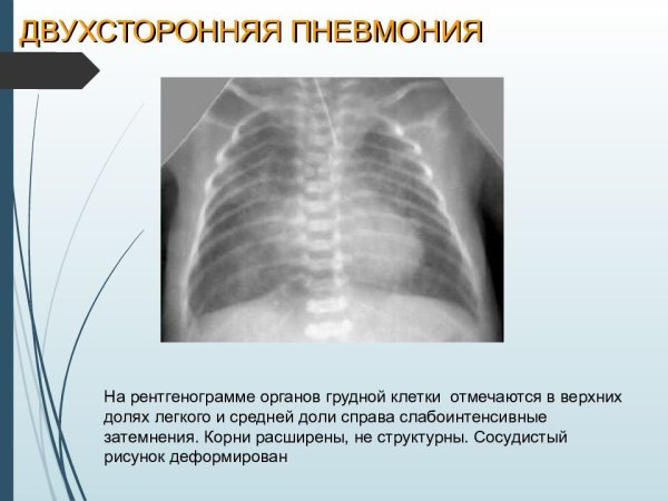 Усиление легочного рисунка причины