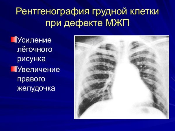 Синдром патологических изменений легочного рисунка