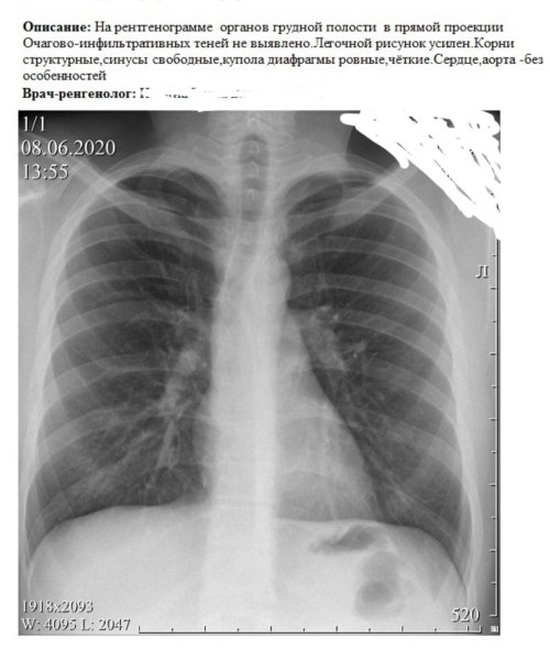 Пневмокониоз легких 1 стадия рентген