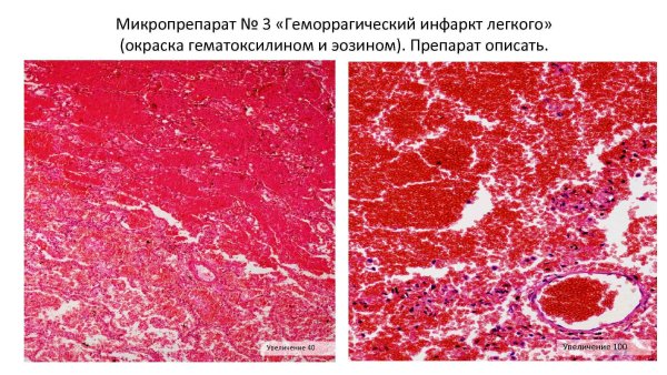 Красный инфаркт легкого микропрепарат