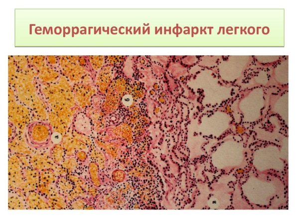 Патанатомия микропрепарат инфаркт легкого