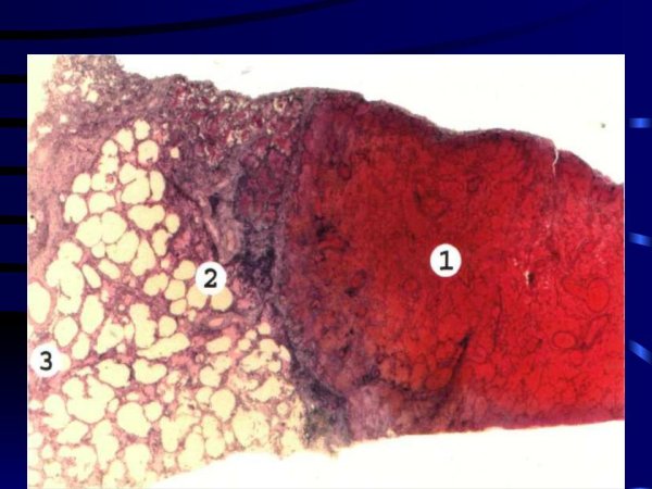 Геморрагический инфаркт легкого микропрепарат