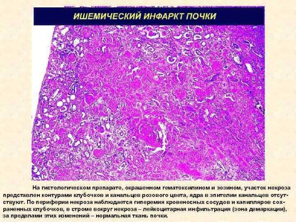 Инфаркт легкого патанатомия