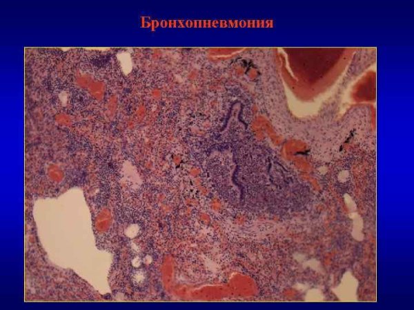Геморрагический инфаркт легкого гематоксилин эозин