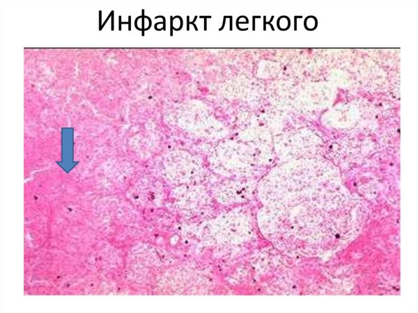 Инфаркт лёгкого макропрепарат