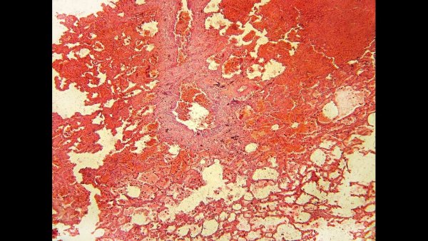 Ишемический инфаркт микропрепарат