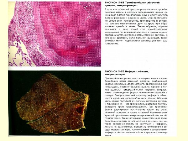 Отек легкого препарат патанатомия