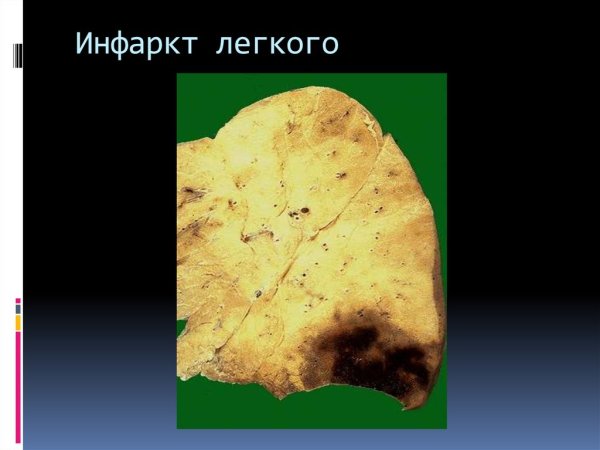 Геморрагический инфаркт легкого патанатомия