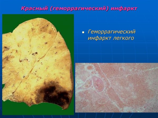 Ишемический инфаркт миокарда микропрепарат