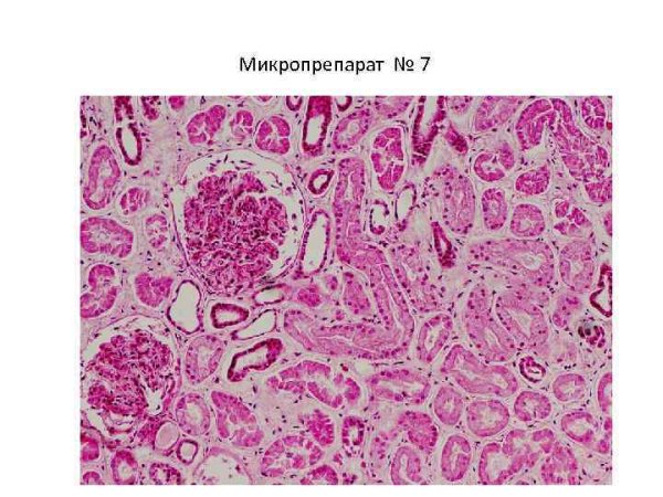 Инфаркт стенки кишки препарат