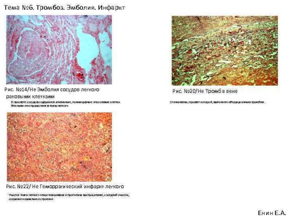 Геморрагический инфаркт легких микропрепарат