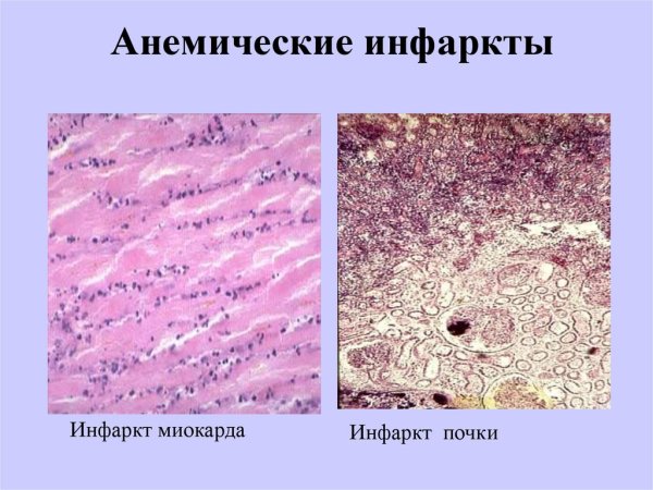 Бурая индурация легкого патанатомия
