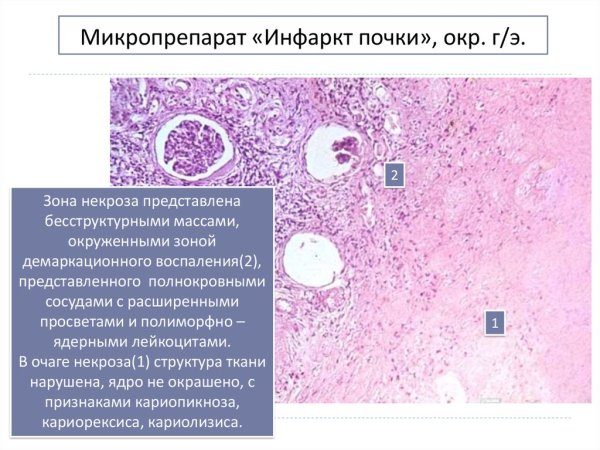 Шоковая почка патанатомия