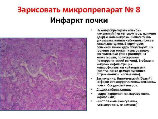 Бурая индурация легких патанатомия