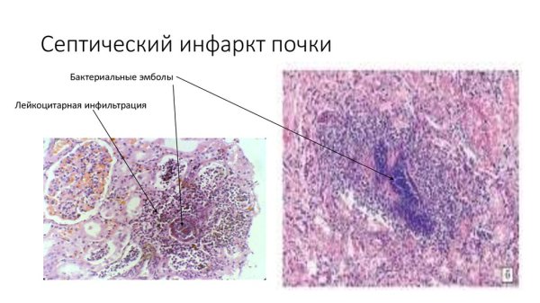 Фокальный некроз почки препарат патанатомия