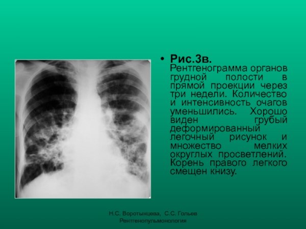 Рентгенограмма органов грудной полости в прямой проекции