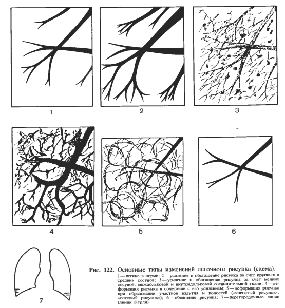 Ячеистая деформация легочного рисунка