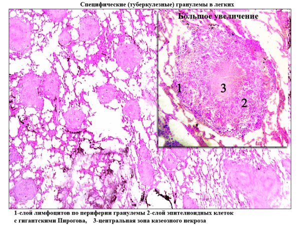 Туберкулёзнач шранулема микр