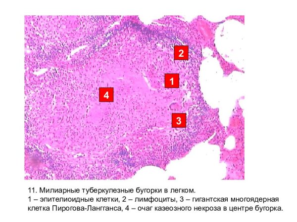 Милиарный туберкулез легких микропрепарат