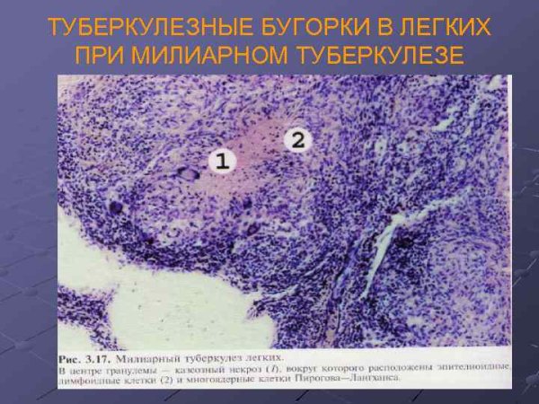 Милиарный туберкулез легкого патанатомия