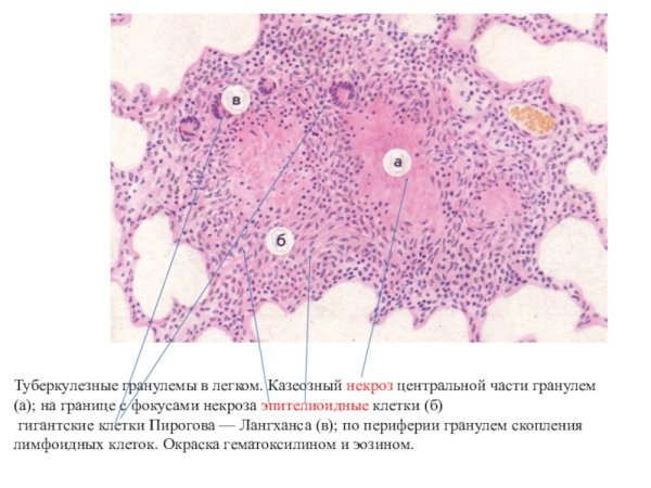 Эпителиоидная гранулема