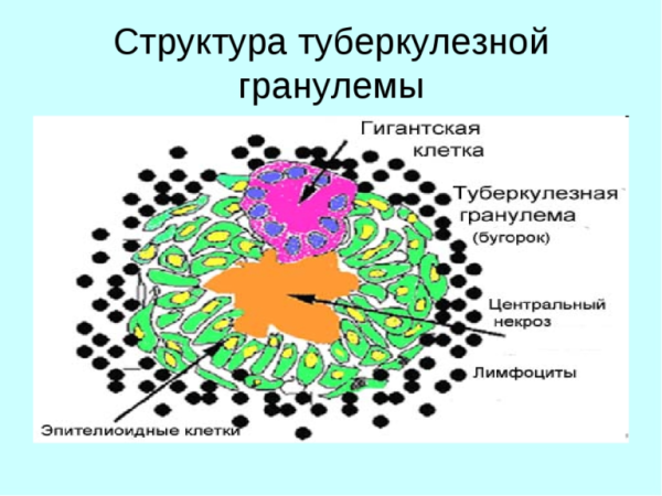 Строение туберкулезной гранулемы