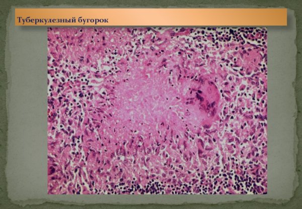 Туберкулез кишечника микропрепарат