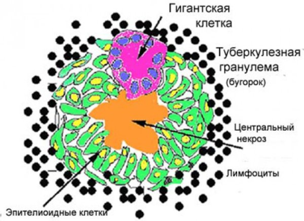 Структуры туберкулезной гранулемы клеточный состав
