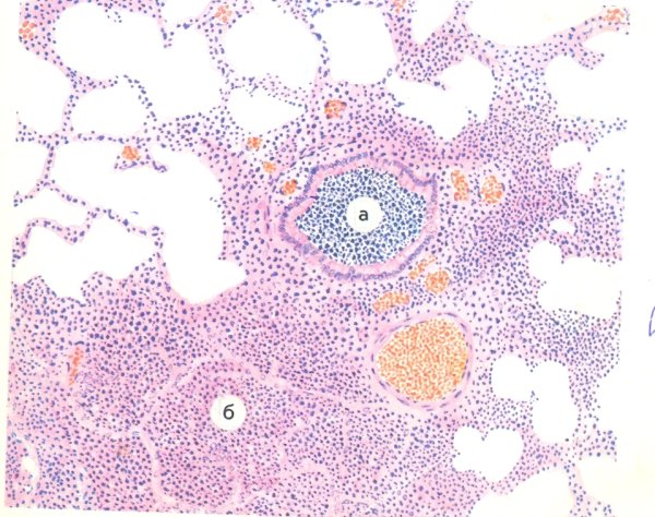 Очаговая пневмомния микро