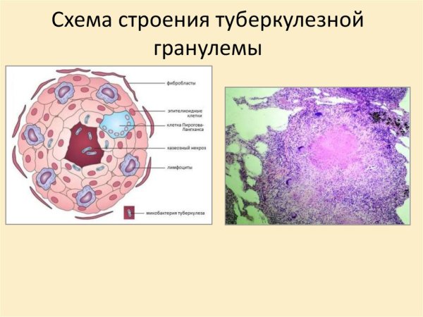 Структура туберкулезной гранулемы
