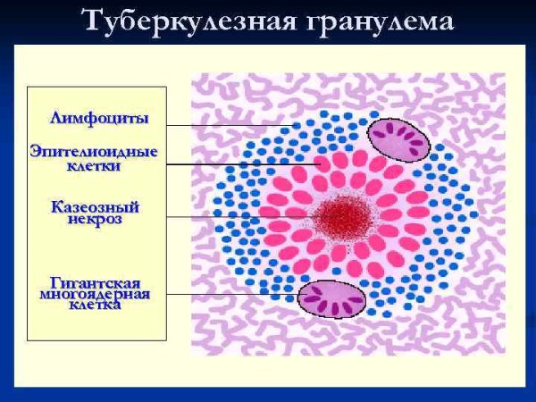 Строение гранулемы при туберкулезе