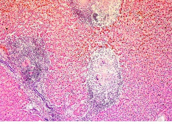 Туберкулезная гранулема в печени